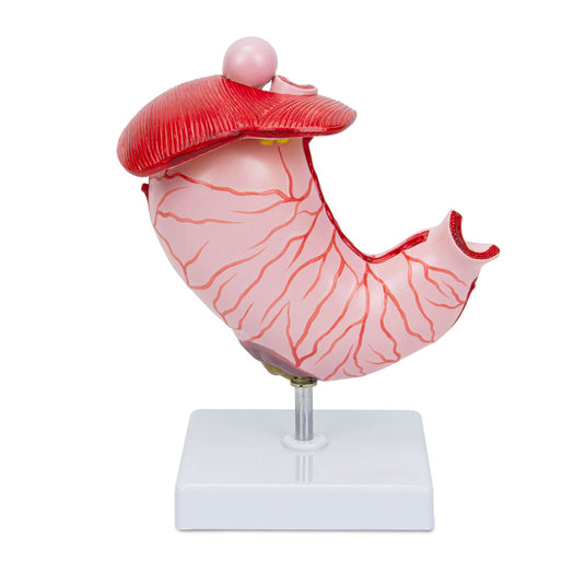 Mô hình Dạ dày với Loét Dạ dày [Mã sản phẩm: MG23162]