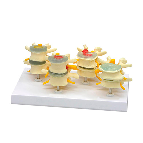 Mô hình đốt sống thắt lưng, 4 giai đoạn [Mã sản phẩm: MG36171]